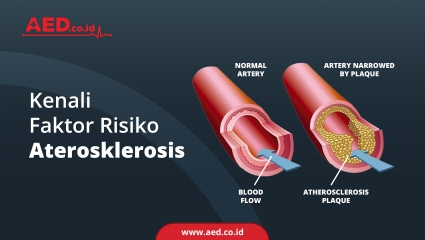 Kenali Faktor Risiko Aterosklerosis 